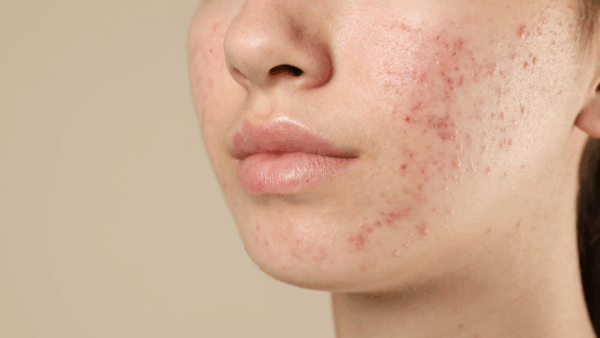 Acne che non passa: e se fosse collegata al tuo intestino?