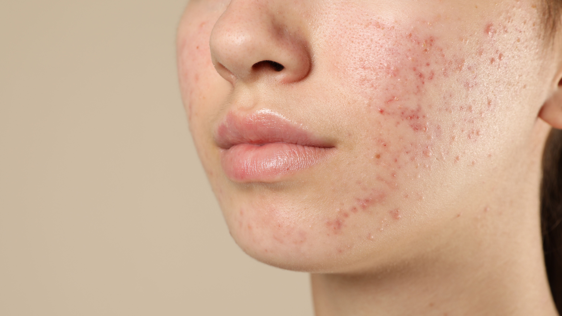 Acne che non passa: e se fosse collegata al tuo intestino?