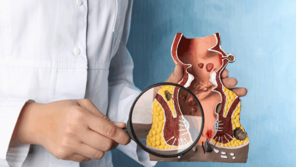 Emorroidi e ragadi anali: l’approccio nutrizionale-funzionale che aiuta davvero