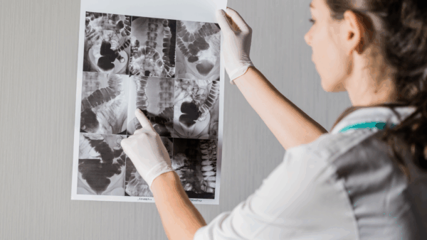 Stitichezza cronica e dolicocolon: perché l’intestino rallenta