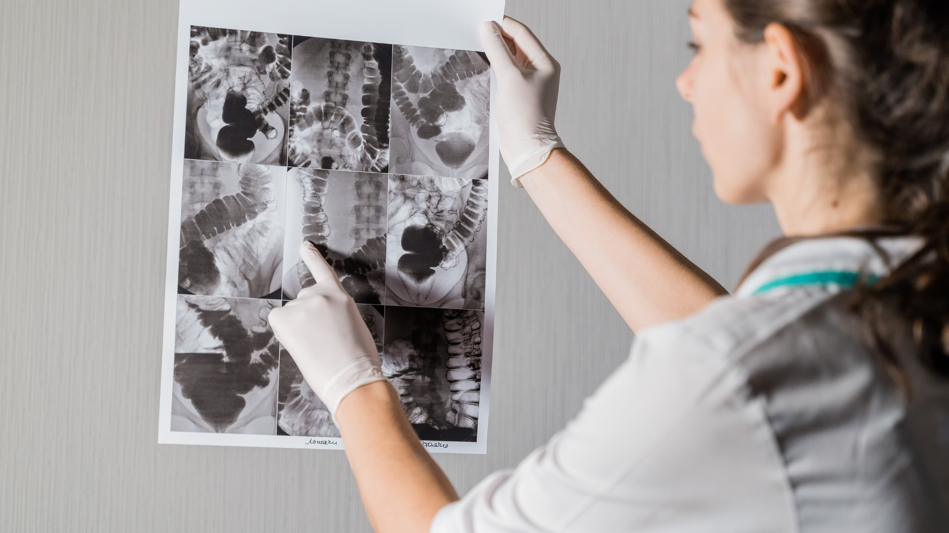 Stitichezza cronica e dolicocolon: perché l’intestino rallenta